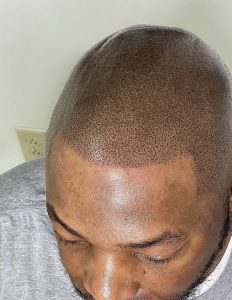 scalp micropigmentation smp