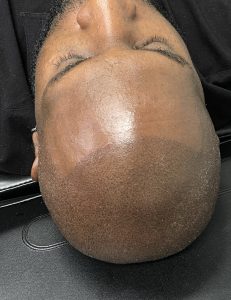 Scalp Micropigmentation